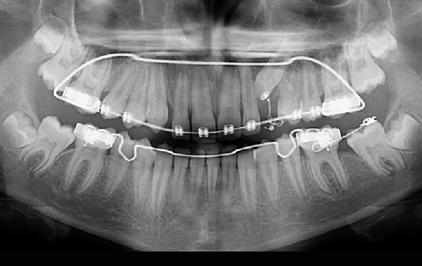 La traction chirurgico-orthodontique des dents incluses