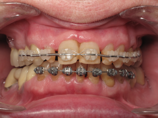 Orthodontie senior : exemple de préparation prothétique