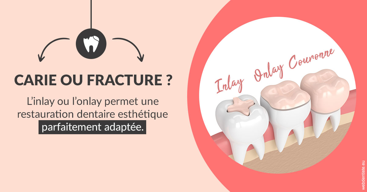 https://dr-hildwein-marc.chirurgiens-dentistes.fr/T2 2023 - Carie ou fracture 2