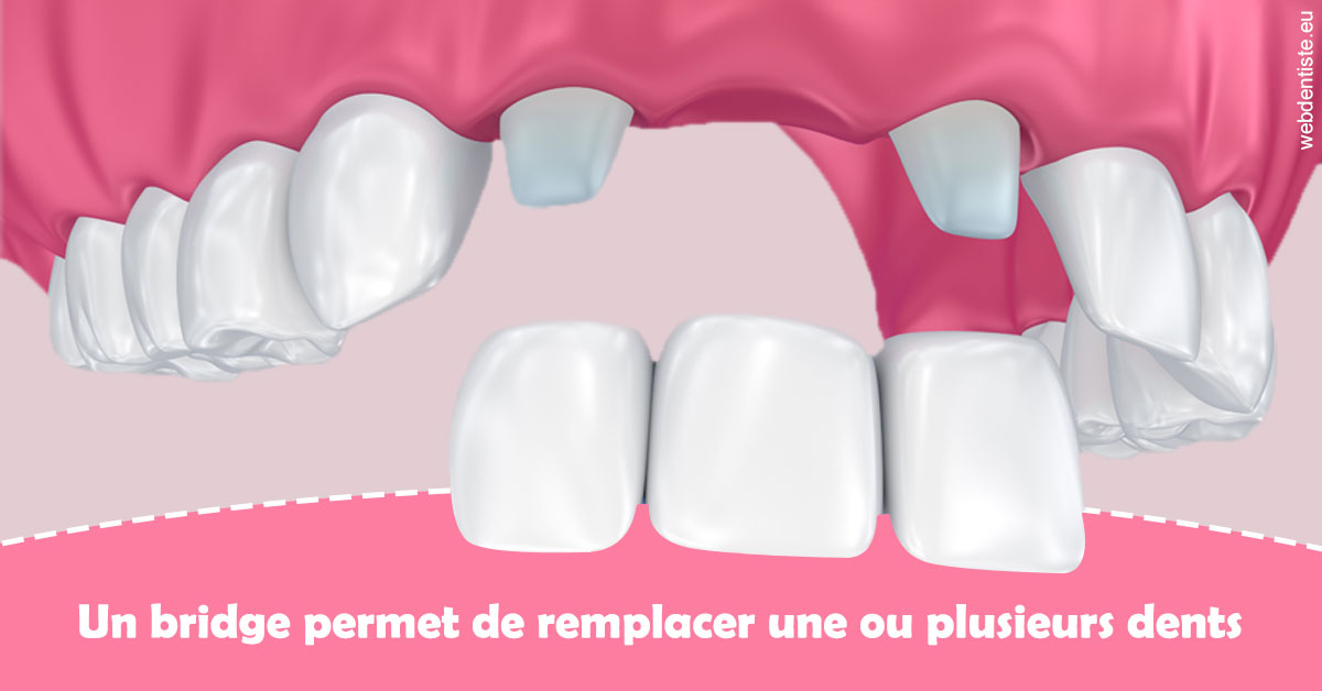 https://dr-hildwein-marc.chirurgiens-dentistes.fr/Bridge remplacer dents 2