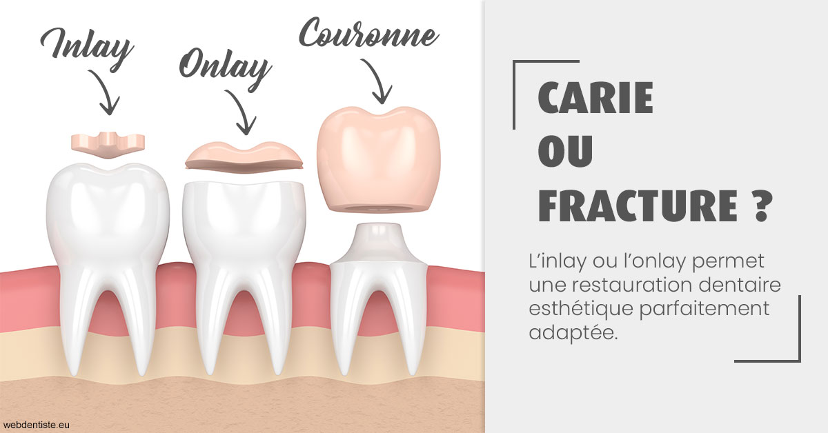 https://dr-hildwein-marc.chirurgiens-dentistes.fr/T2 2023 - Carie ou fracture 1