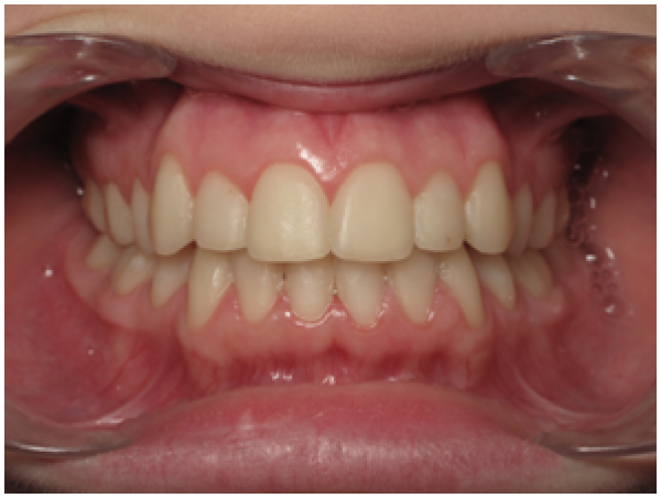 Correction des encombrements dentaires par extraction de prémolaires chez l’adolescent