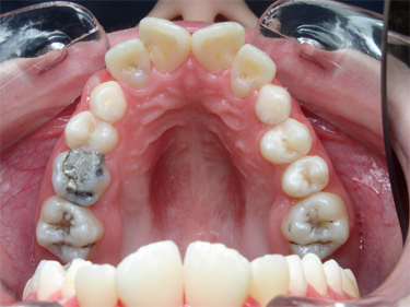 sourire gingival - 3