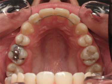 sourire gingival - 9