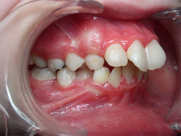 sourire gingival - 2