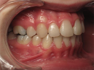 sourire gingival - 8