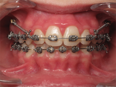sourire gingival - 5
