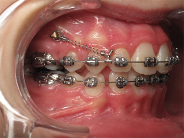 sourire gingival - 4