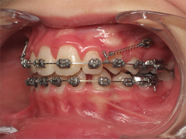 sourire gingival - 6