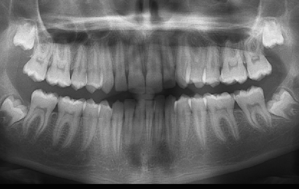 La traction chirurgico-orthodontique des dents incluses3