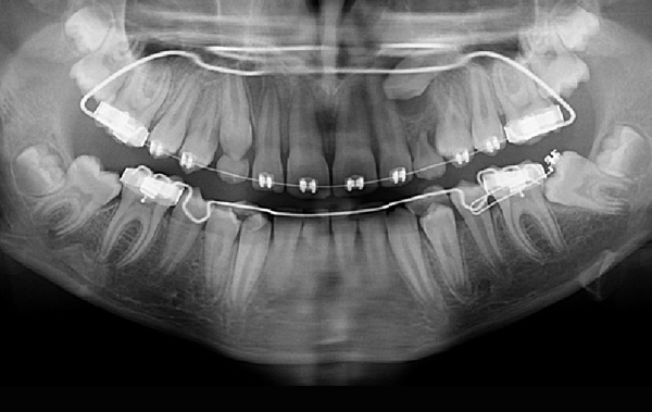 La traction chirurgico-orthodontique des dents incluses1